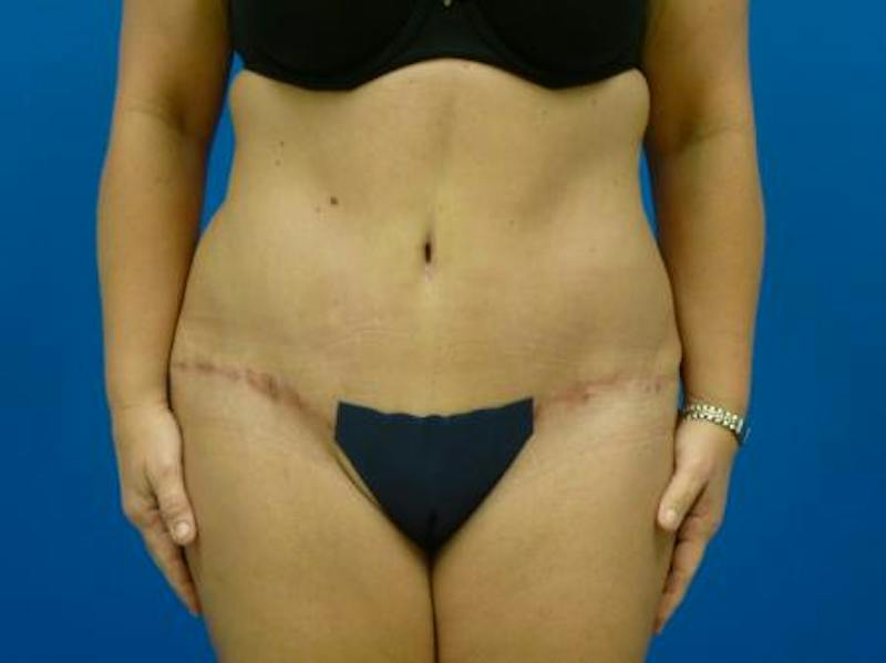 Tummy Tuck Before & After Gallery - Patient 112037 - Image 2
