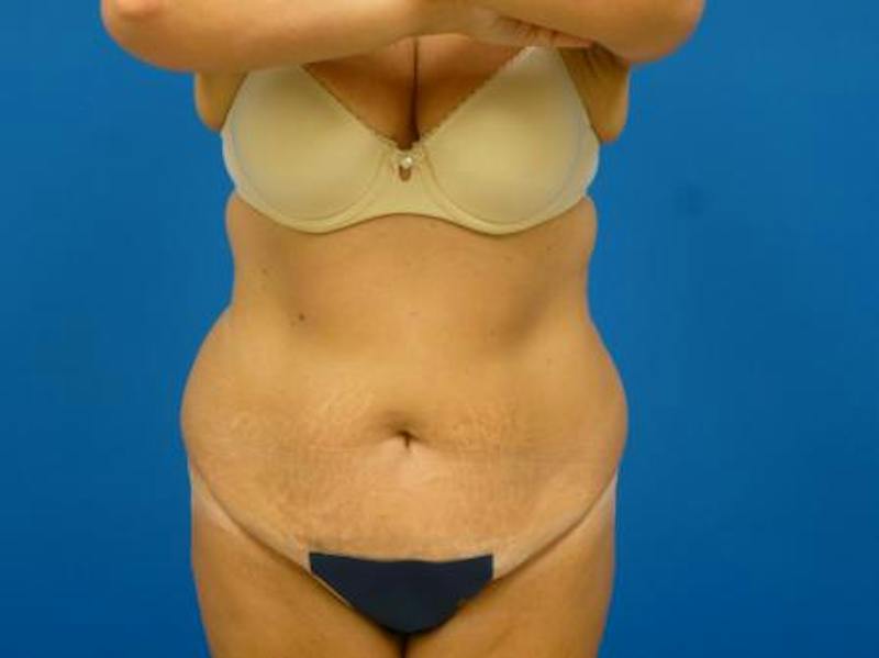 Tummy Tuck Before & After Gallery - Patient 112037 - Image 3
