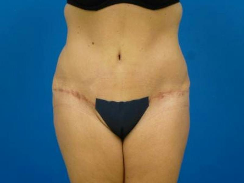 Tummy Tuck Before & After Gallery - Patient 112037 - Image 4