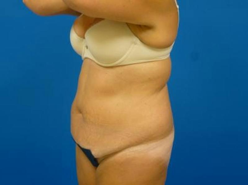 Tummy Tuck Before & After Gallery - Patient 112037 - Image 5