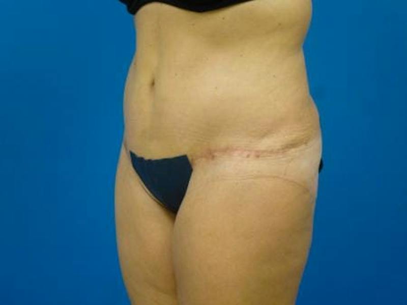 Tummy Tuck Before & After Gallery - Patient 112037 - Image 6