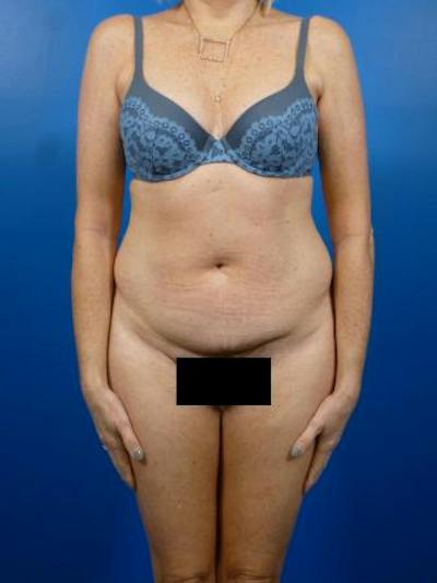 Tummy Tuck Before & After Gallery - Patient 129198 - Image 1