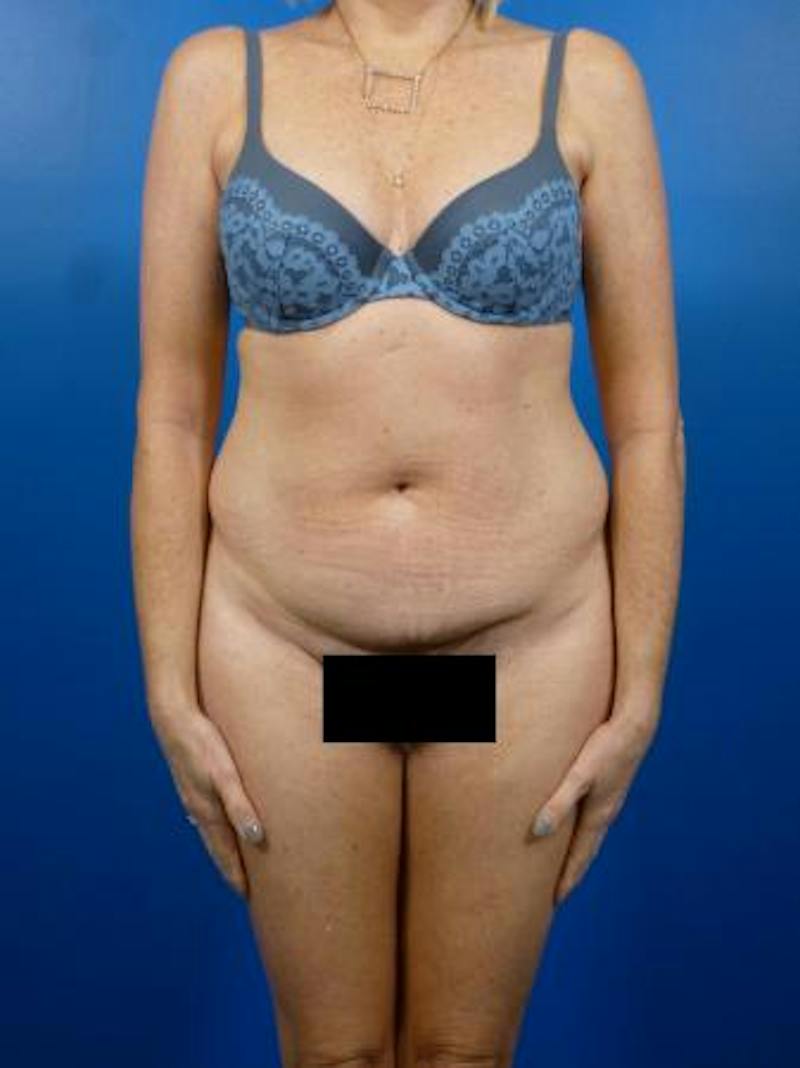 Tummy Tuck Before & After Gallery - Patient 129198 - Image 1