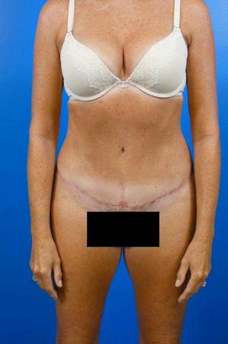 Tummy Tuck Before & After Gallery - Patient 129198 - Image 2
