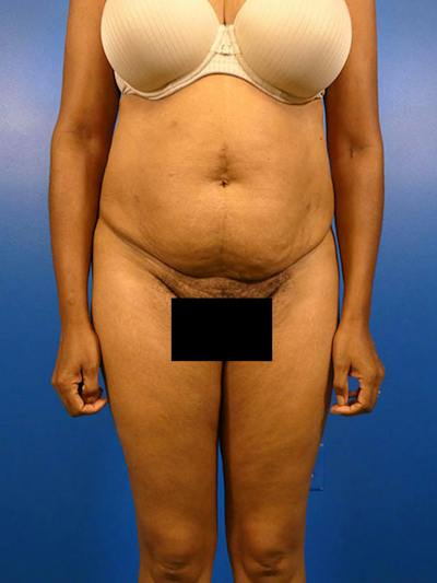 Tummy Tuck Before & After Gallery - Patient 136406 - Image 1