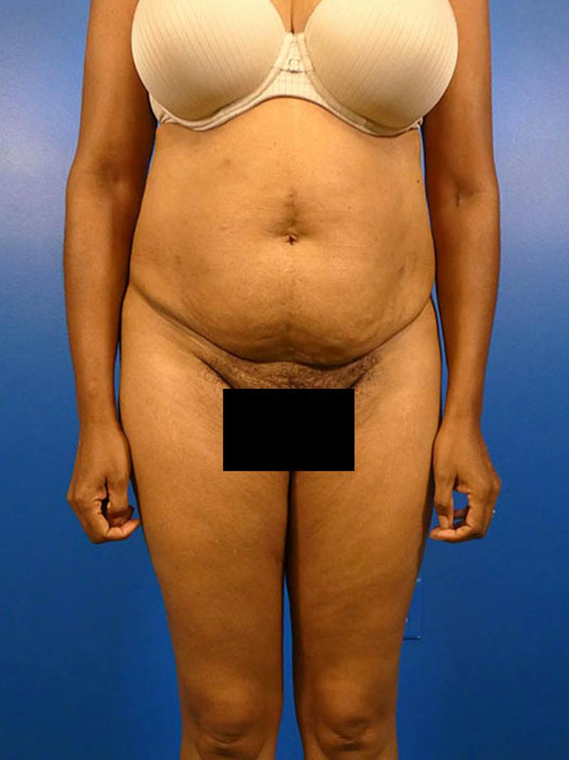 Tummy Tuck Before & After Gallery - Patient 136406 - Image 1