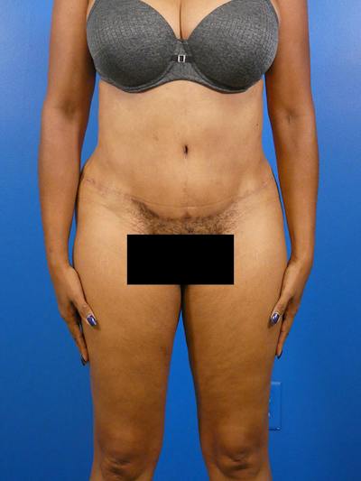 Tummy Tuck Before & After Gallery - Patient 136406 - Image 2