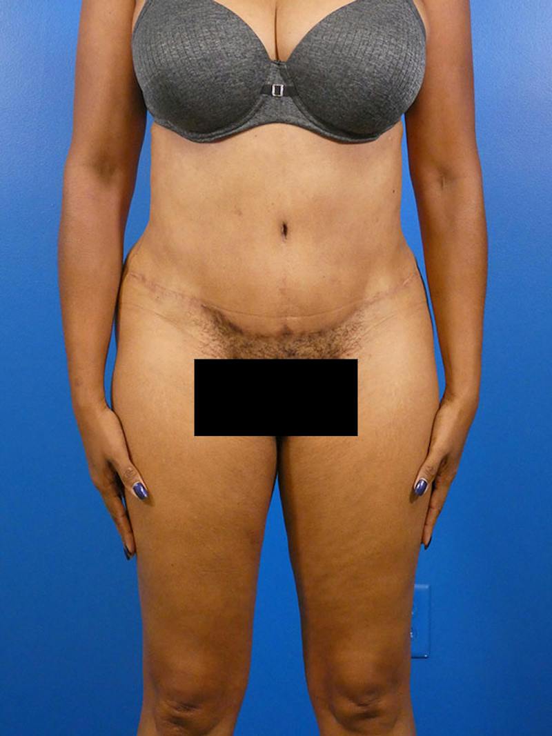 Tummy Tuck Before & After Gallery - Patient 136406 - Image 2