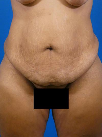 Tummy Tuck Before & After Gallery - Patient 120840 - Image 1