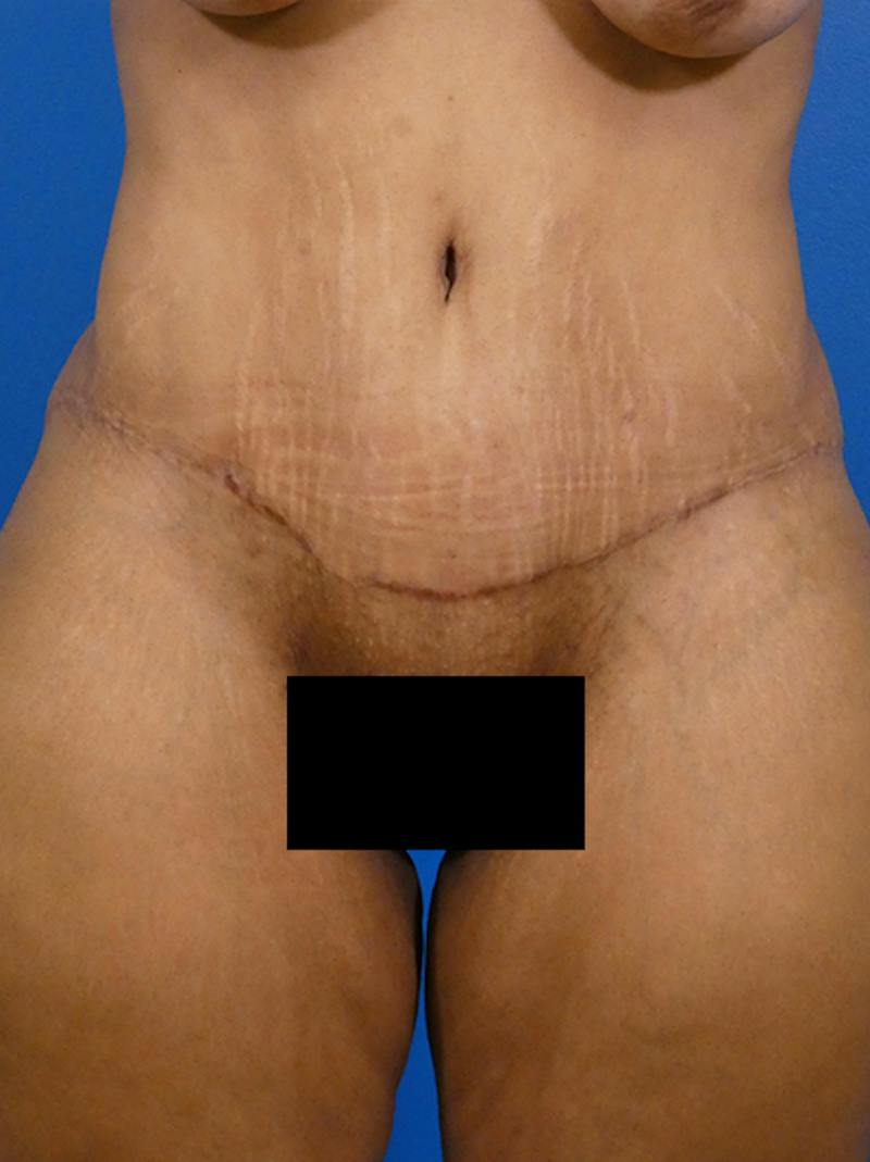 Tummy Tuck Before & After Gallery - Patient 120840 - Image 2