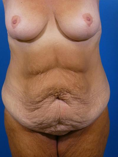 Tummy Tuck Before & After Gallery - Patient 644339 - Image 1