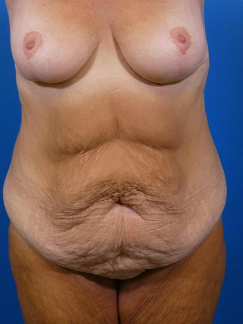 Tummy Tuck Before & After Gallery - Patient 644339 - Image 1
