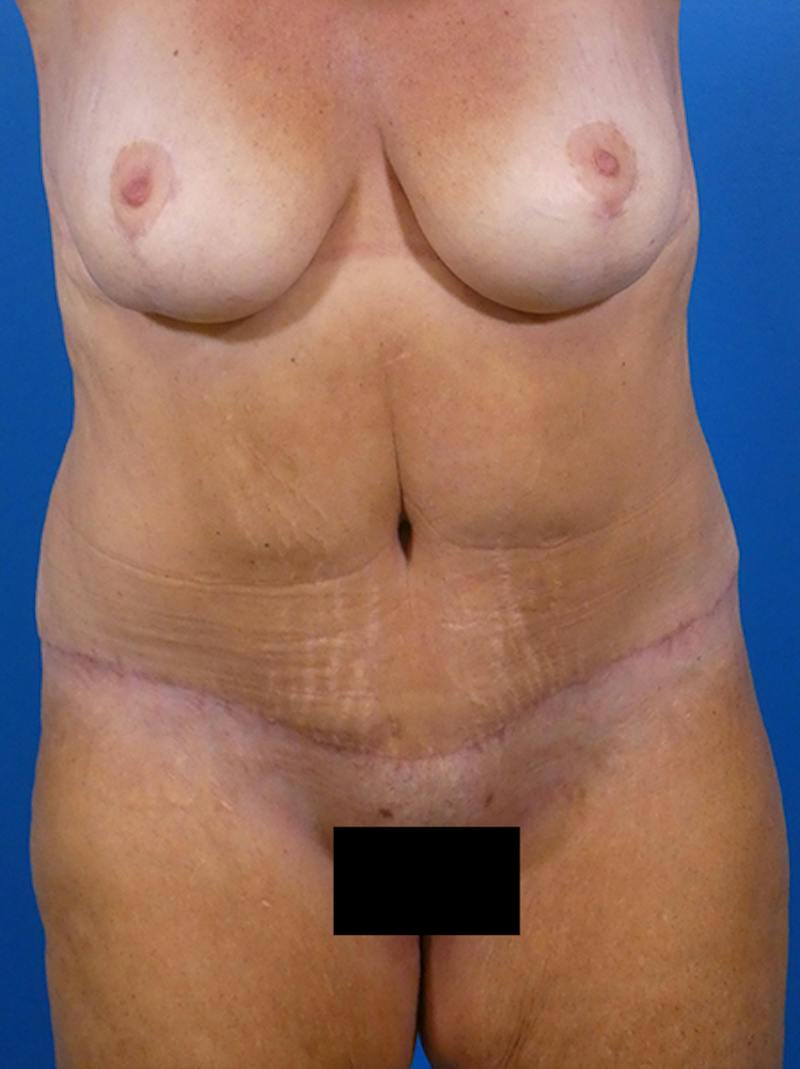 Tummy Tuck Before & After Gallery - Patient 644339 - Image 2