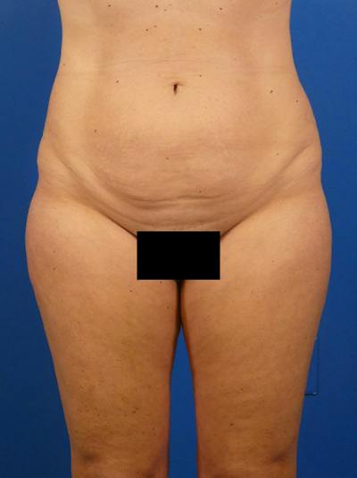 Tummy Tuck Before & After Gallery - Patient 771073 - Image 1
