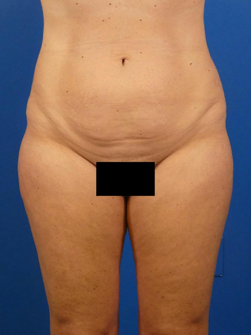 Tummy Tuck Before & After Gallery - Patient 771073 - Image 1