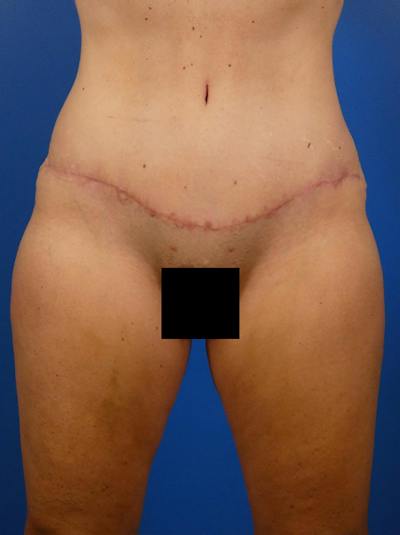 Tummy Tuck Before & After Gallery - Patient 771073 - Image 2