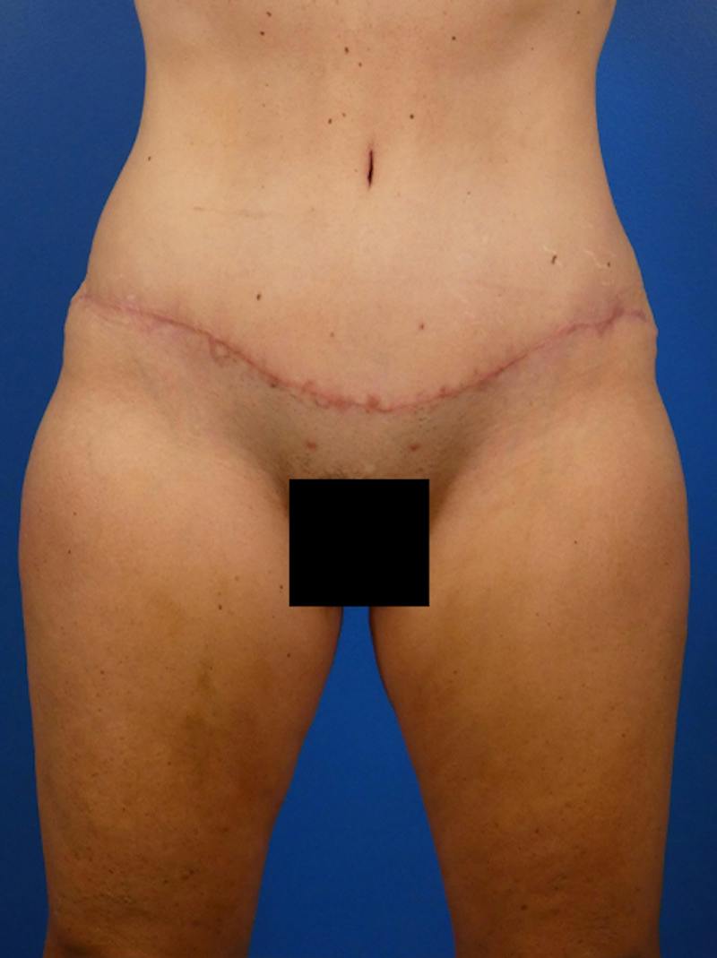 Tummy Tuck Before & After Gallery - Patient 771073 - Image 2