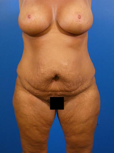 Tummy Tuck Before & After Gallery - Patient 183867 - Image 1
