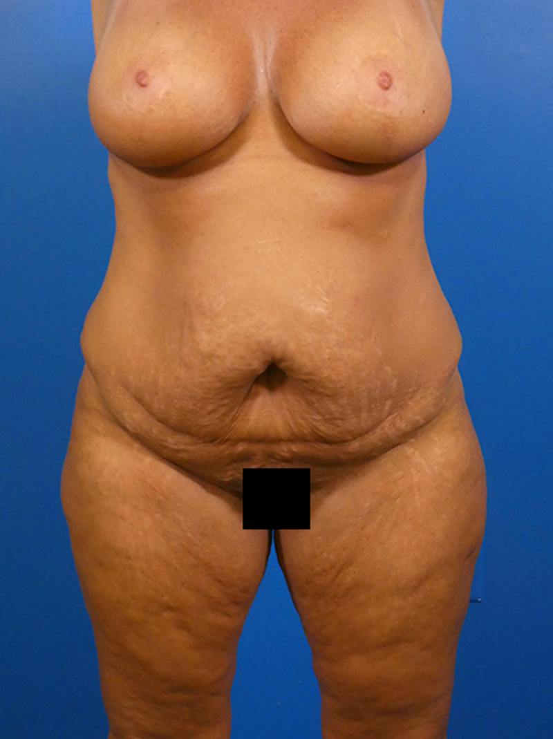 Tummy Tuck Before & After Gallery - Patient 183867 - Image 1