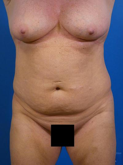 Tummy Tuck Before & After Gallery - Patient 149176 - Image 1