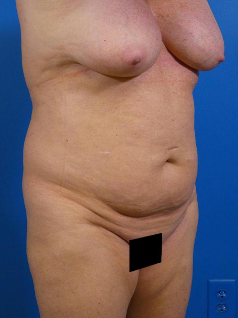 Tummy Tuck Before & After Gallery - Patient 149176 - Image 3