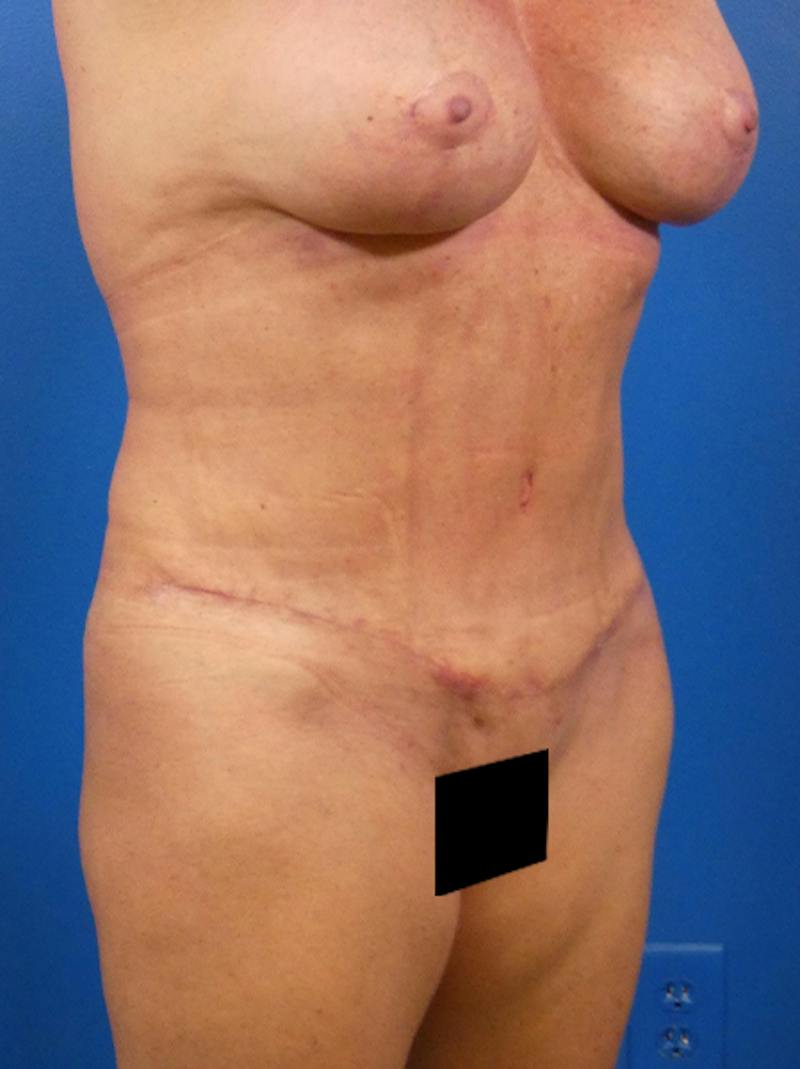 Tummy Tuck Before & After Gallery - Patient 149176 - Image 4
