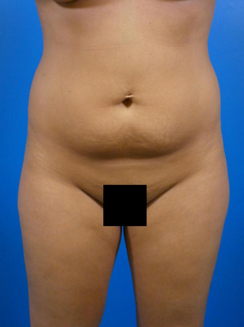 Tummy Tuck Before & After Gallery - Patient 293166 - Image 1