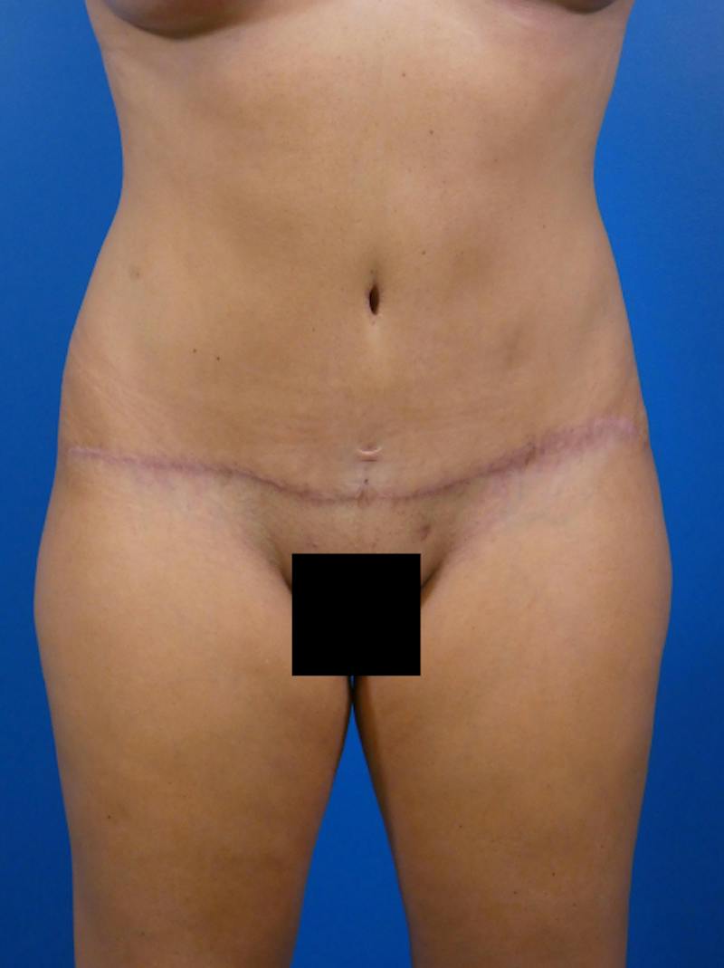 Tummy Tuck Before & After Gallery - Patient 293166 - Image 2