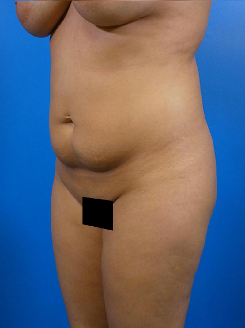 Tummy Tuck Before & After Gallery - Patient 293166 - Image 3