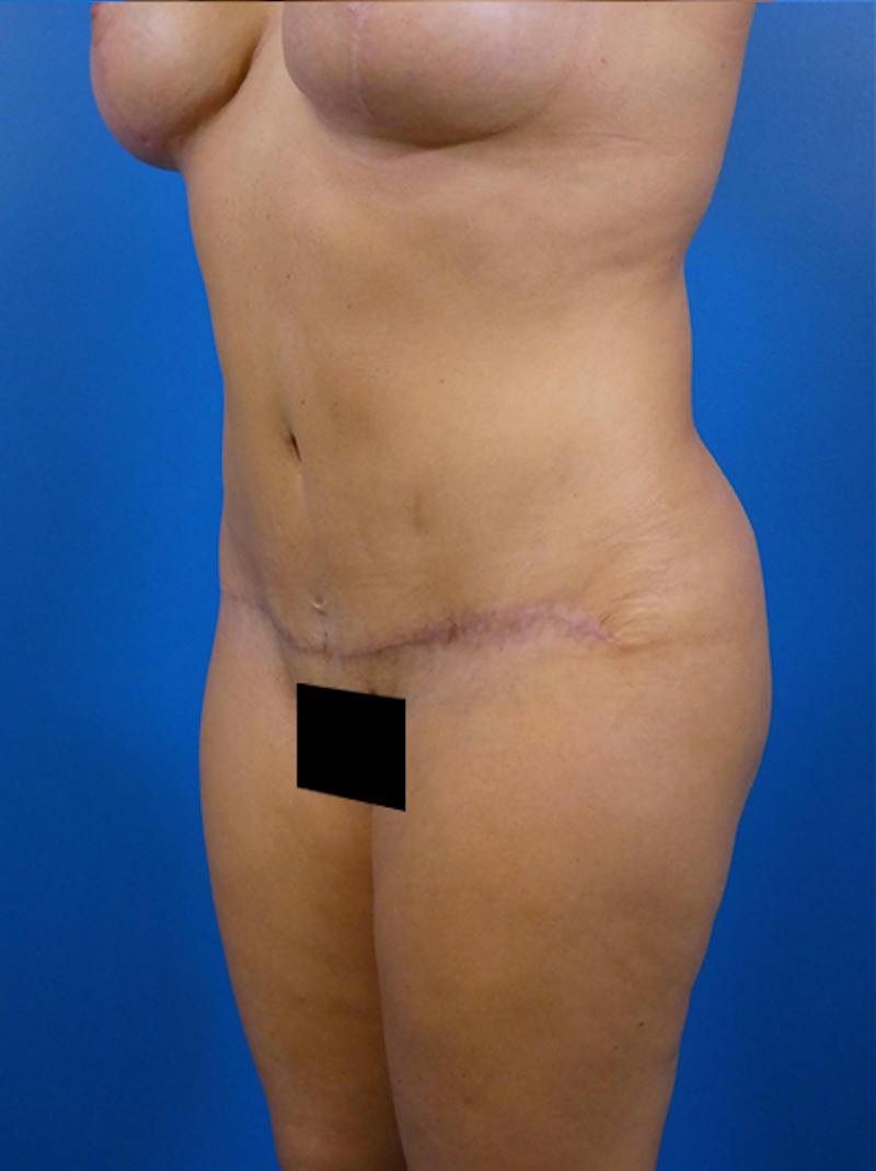 Tummy Tuck Before & After Gallery - Patient 293166 - Image 4