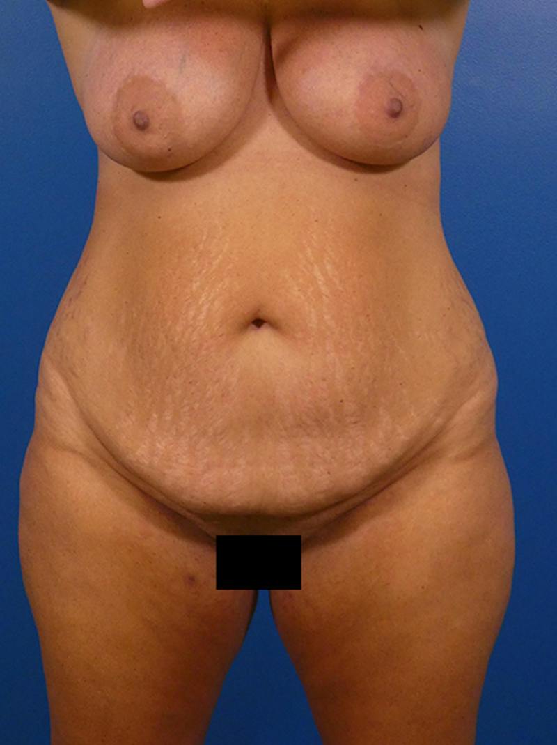 Tummy Tuck Before & After Gallery - Patient 384682 - Image 1