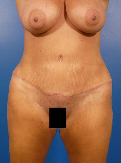 Tummy Tuck Before & After Gallery - Patient 384682 - Image 2