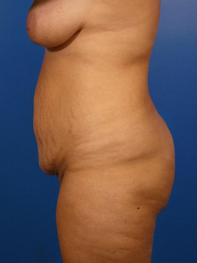 Tummy Tuck Before & After Gallery - Patient 384682 - Image 3