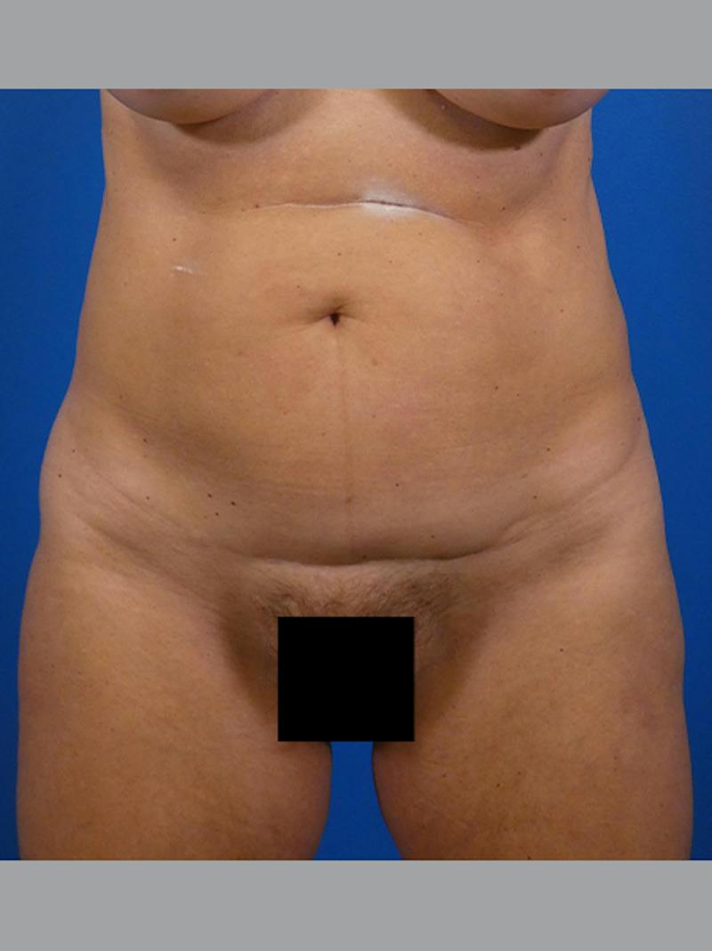 Tummy Tuck Before & After Gallery - Patient 646642 - Image 1