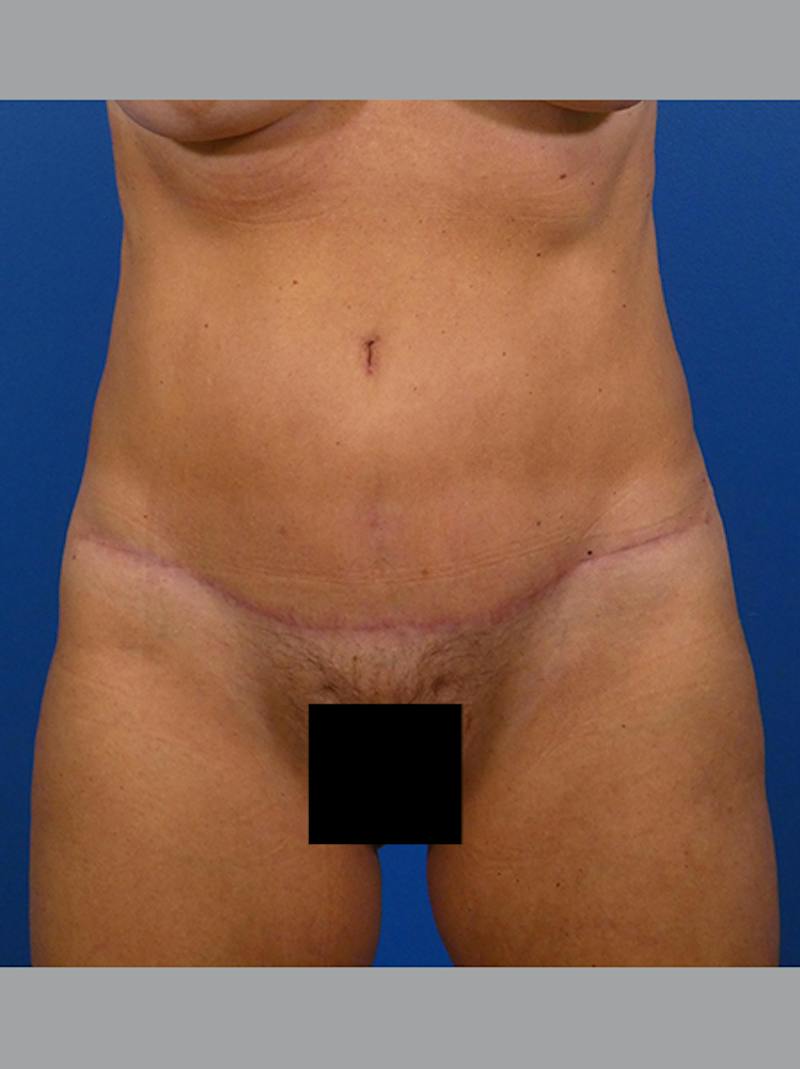 Tummy Tuck Before & After Gallery - Patient 646642 - Image 2