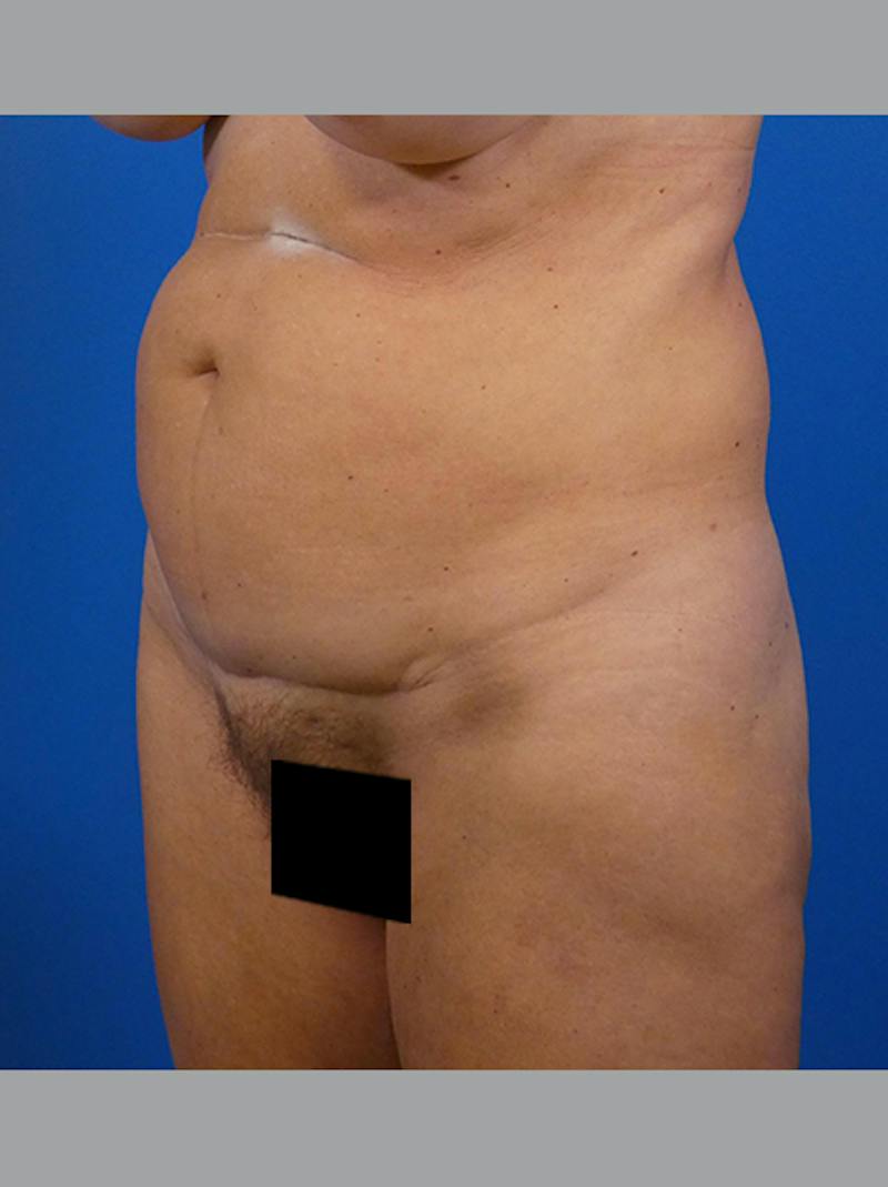 Tummy Tuck Before & After Gallery - Patient 646642 - Image 3