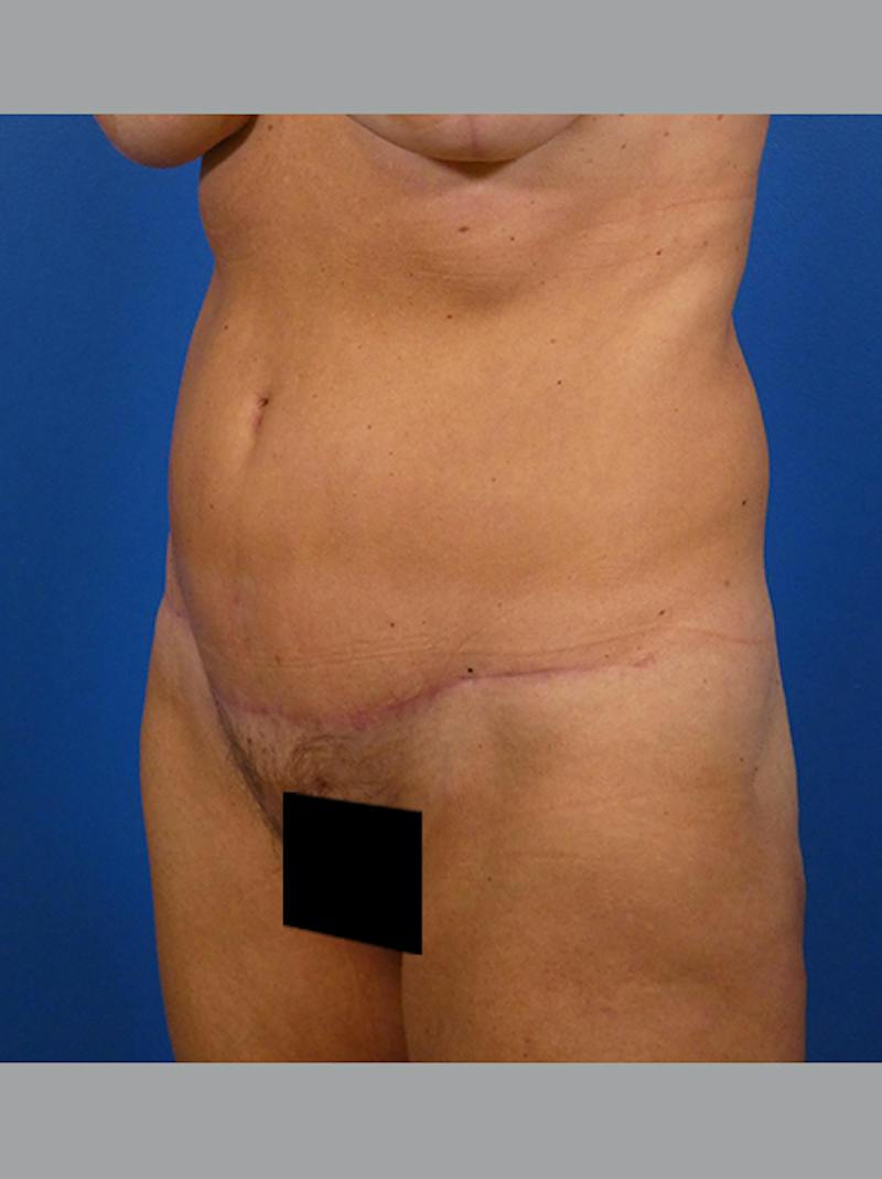Tummy Tuck Before & After Gallery - Patient 646642 - Image 4
