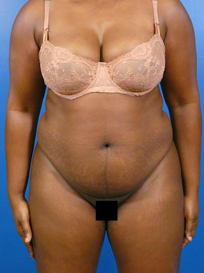 Tummy Tuck Before & After Gallery - Patient 931253 - Image 1