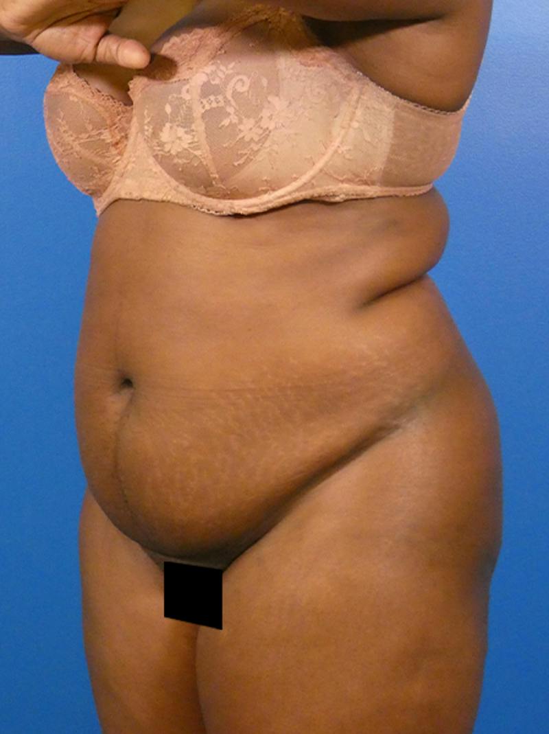Tummy Tuck Before & After Gallery - Patient 931253 - Image 3