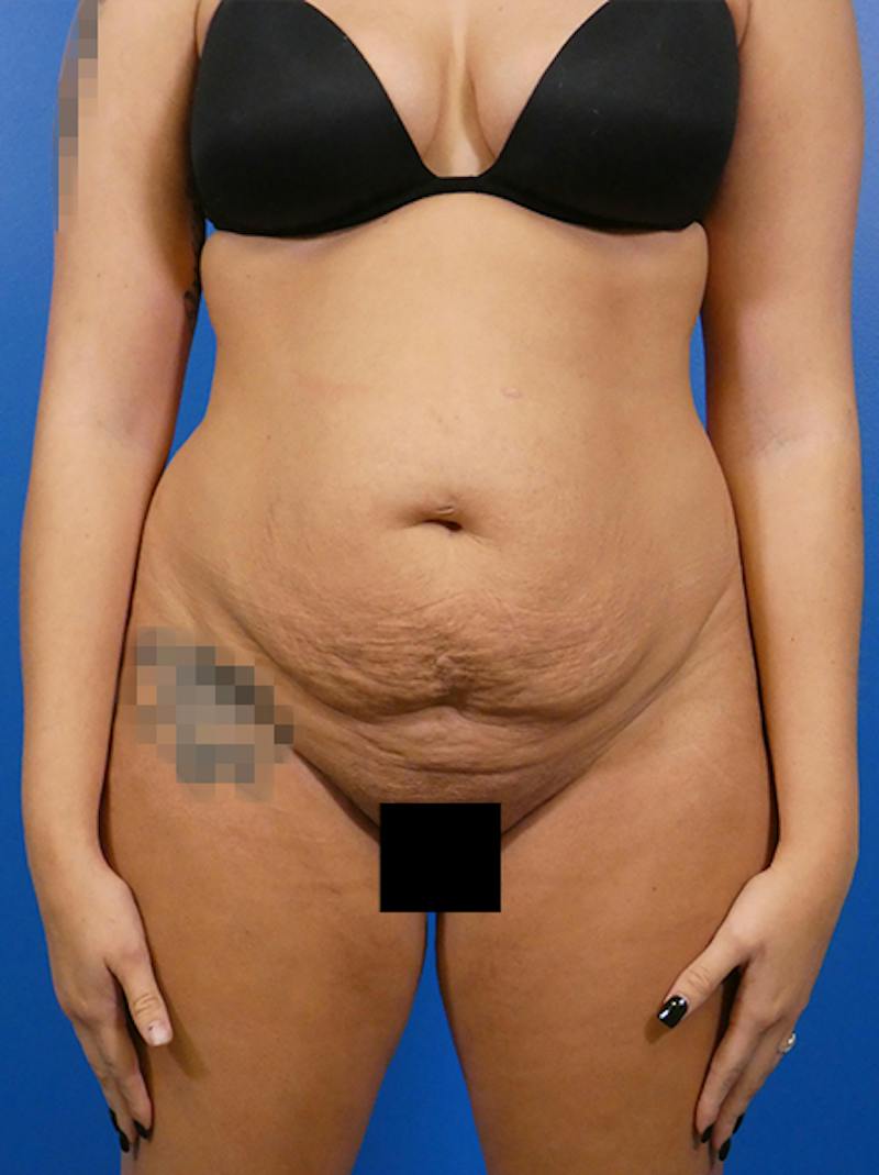 Tummy Tuck Before & After Gallery - Patient 172324 - Image 1