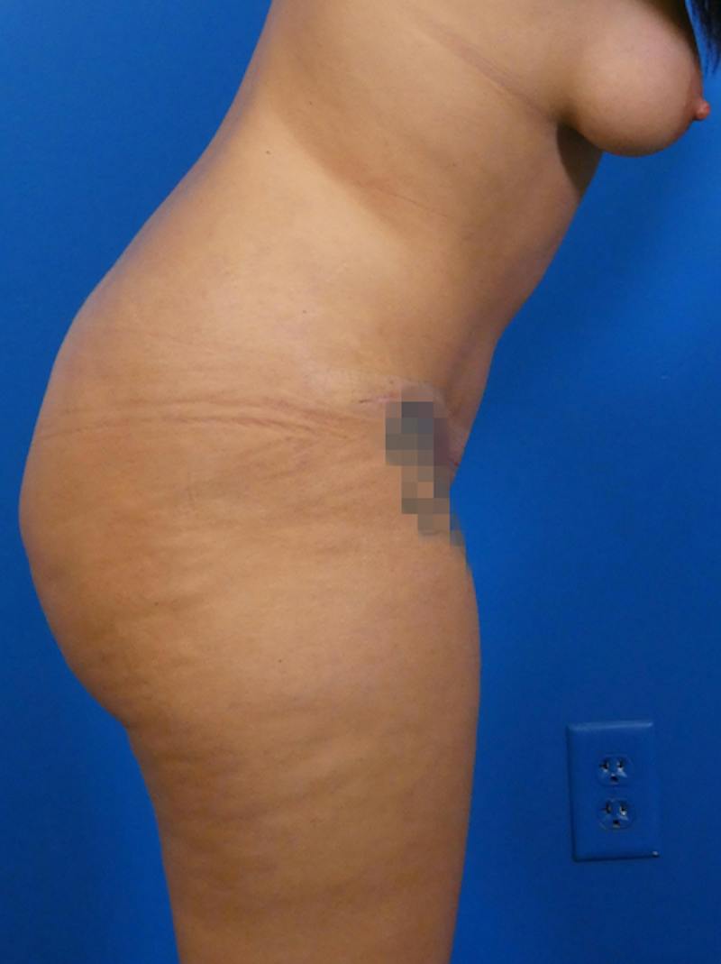 Tummy Tuck Before & After Gallery - Patient 172324 - Image 4