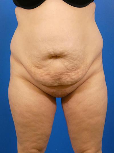 Tummy Tuck Before & After Gallery - Patient 384786 - Image 1