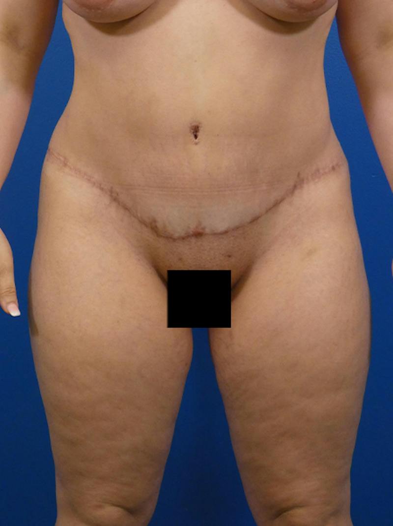 Tummy Tuck Before & After Gallery - Patient 407318 - Image 2