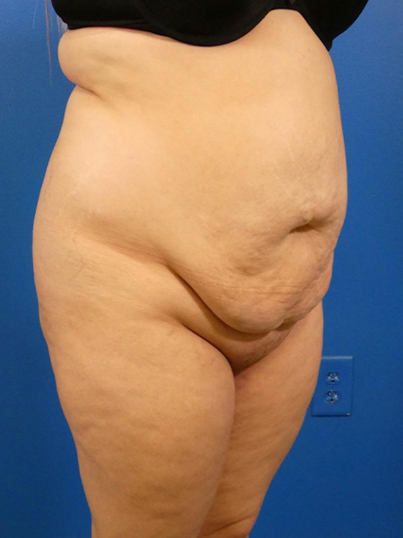 Tummy Tuck Before & After Gallery - Patient 407318 - Image 3