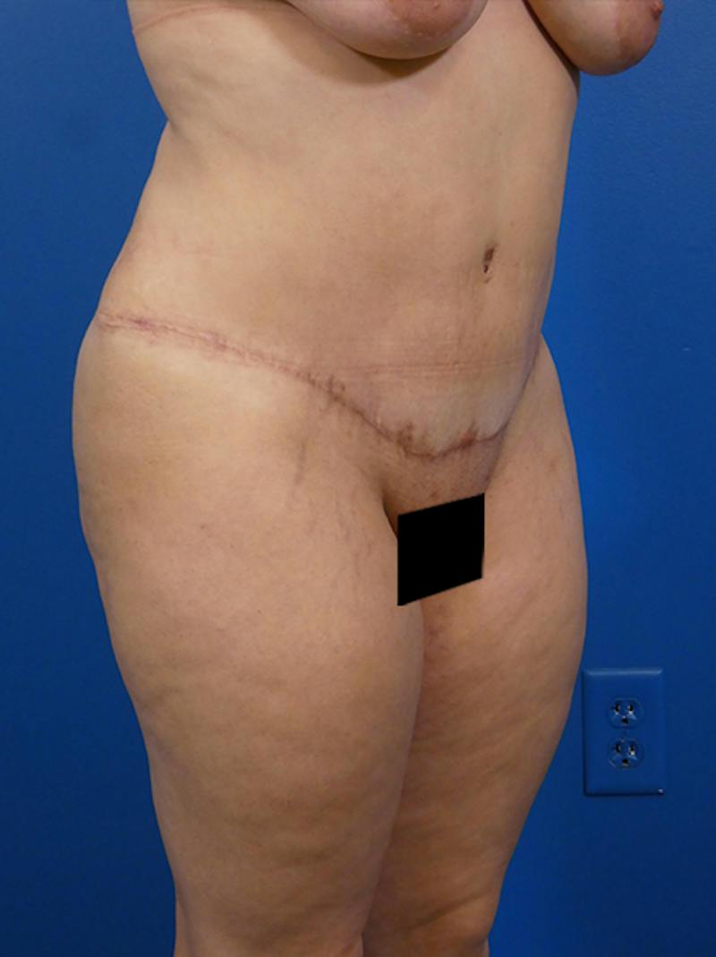 Tummy Tuck Before & After Gallery - Patient 407318 - Image 4