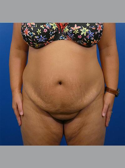 Tummy Tuck Before & After Gallery - Patient 234006 - Image 1