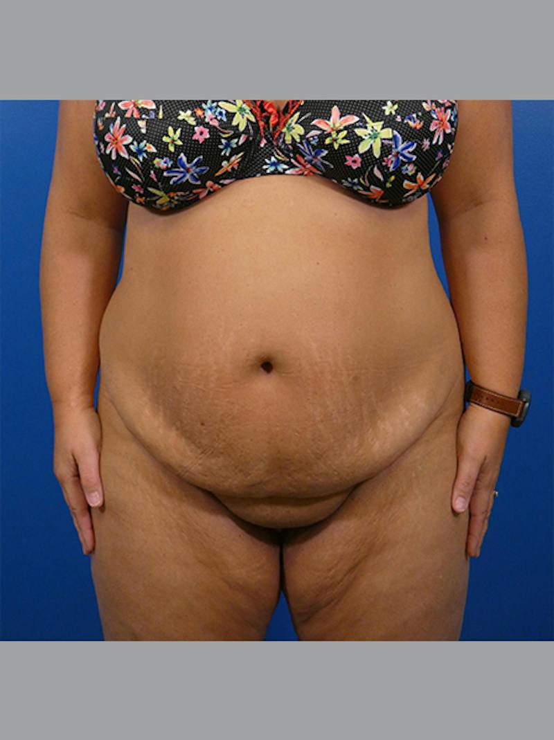 Tummy Tuck Before & After Gallery - Patient 183625 - Image 1