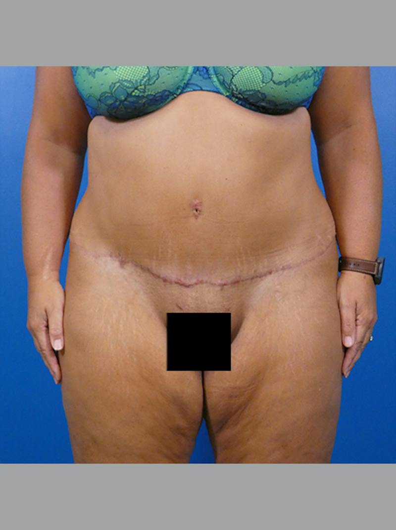 Tummy Tuck Before & After Gallery - Patient 183625 - Image 2