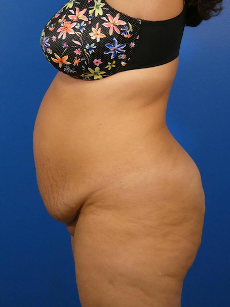 Tummy Tuck Before & After Gallery - Patient 183625 - Image 3