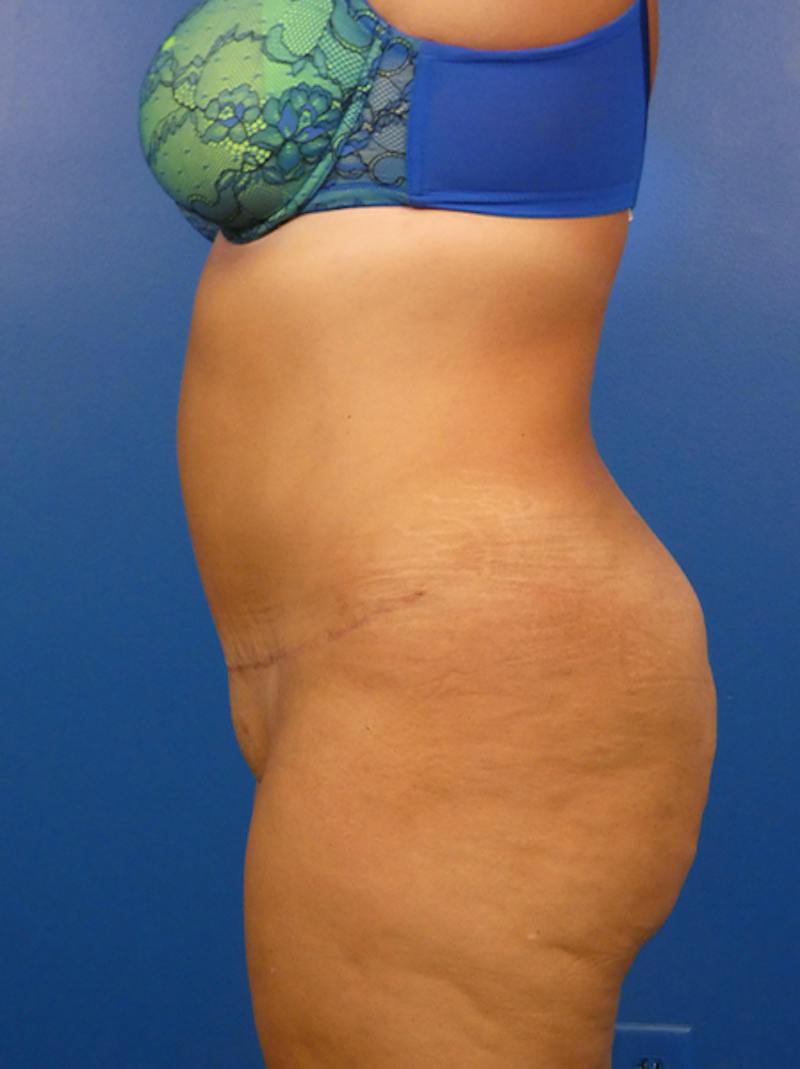 Tummy Tuck Before & After Gallery - Patient 183625 - Image 4